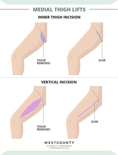 Thigh Lift (Thighplasty): Types, Surgery, Recovery & Scars